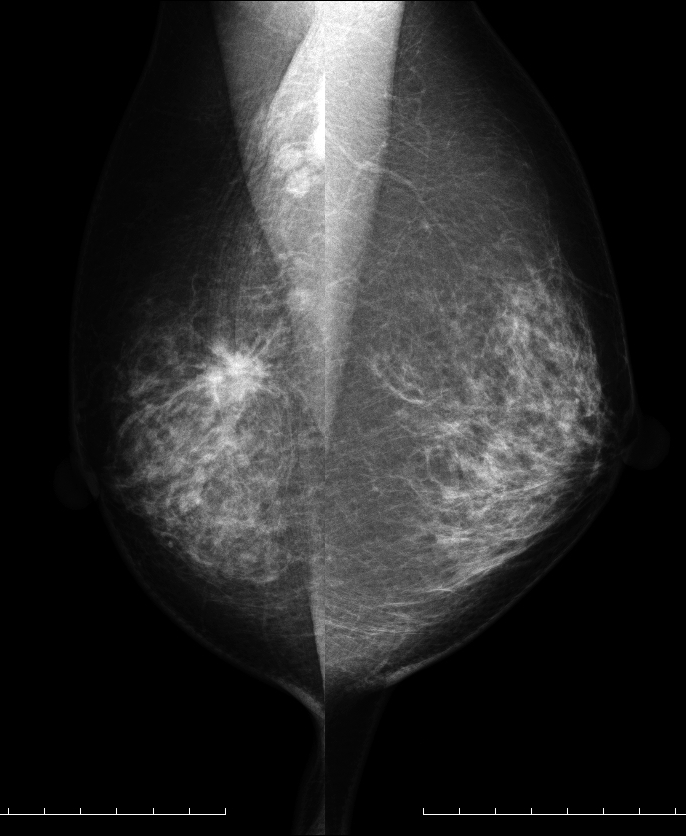症例13 51歳 女性 浸潤性乳管癌 硬癌 マンモグラフィ MLO
