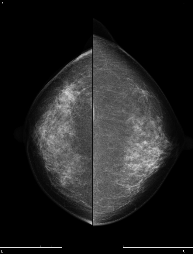 症例13 51歳 女性 浸潤性乳管癌 硬癌 マンモグラフィ CC