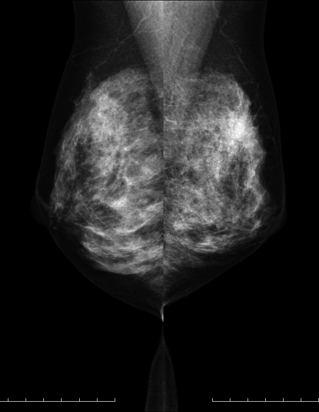 症例14 48歳 女性 浸潤性乳管癌 乳頭腺管癌 マンモグラフィ MLO