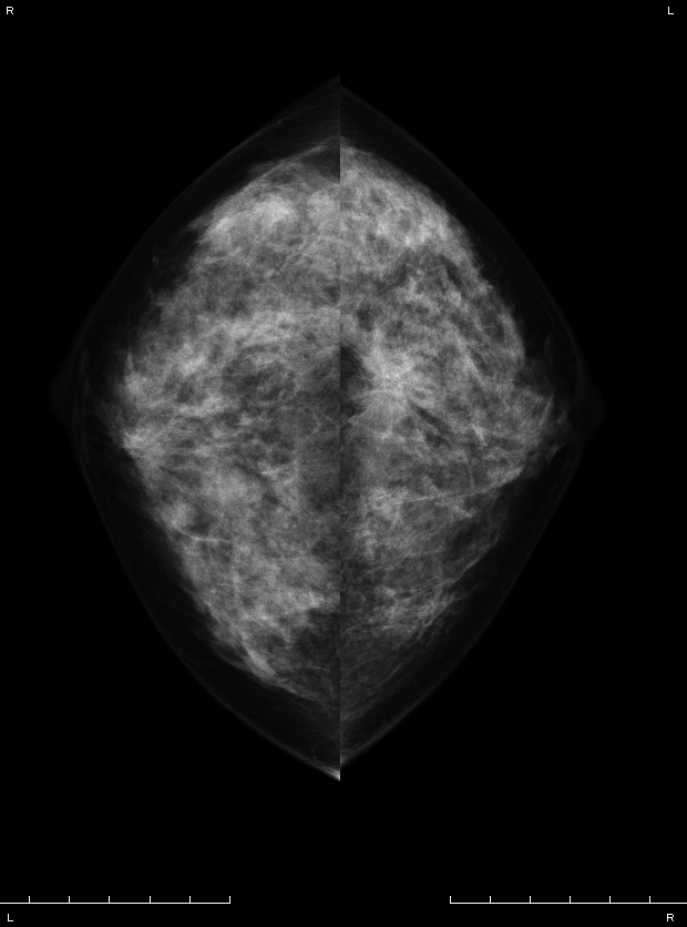 症例14 48歳 女性 浸潤性乳管癌 乳頭腺管癌 マンモグラフィ CC