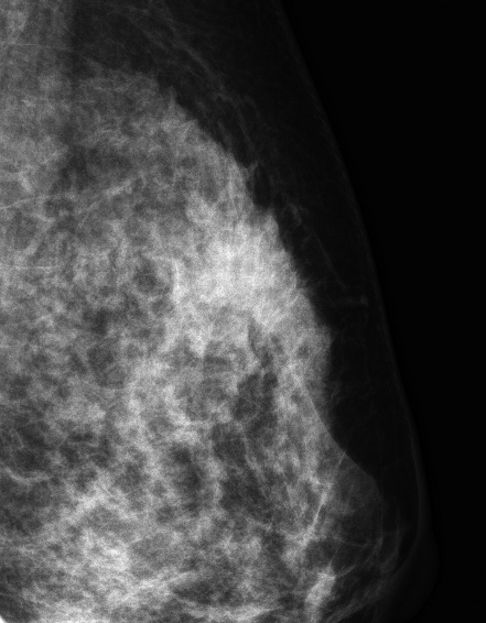 症例14 48歳 女性 浸潤性乳管癌 乳頭腺管癌 マンモグラフィ 左MLO拡大スポット撮影
