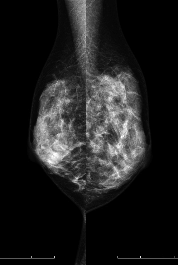症例15 42歳 女性 DCIS 篩状型 面疱型 マンモグラフィ MLO