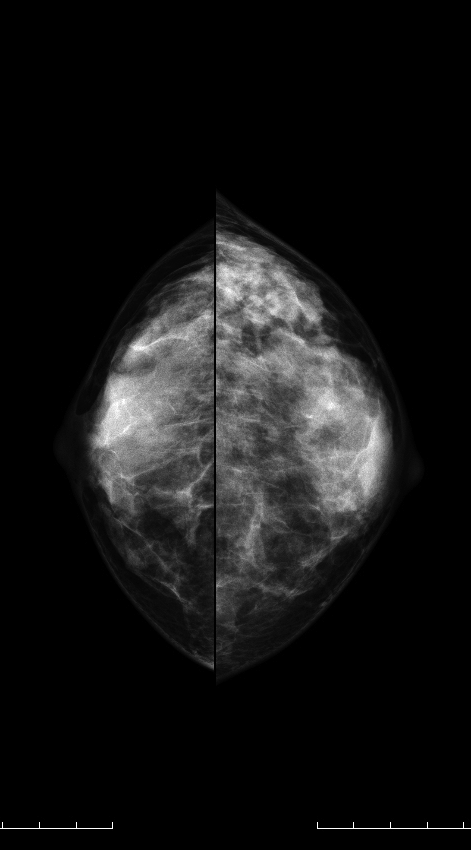 症例15 42歳 女性 DCIS 篩状型 面疱型 マンモグラフィ CC