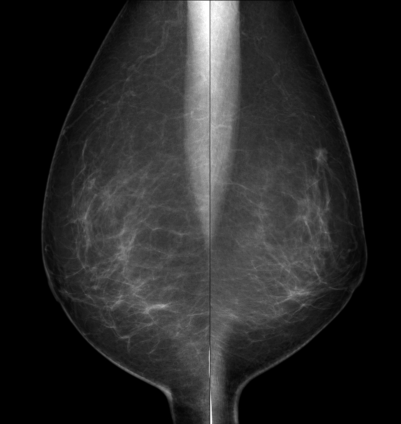 症例17 70歳 女性 浸潤性乳管癌 硬癌 マンモグラフィ MLO