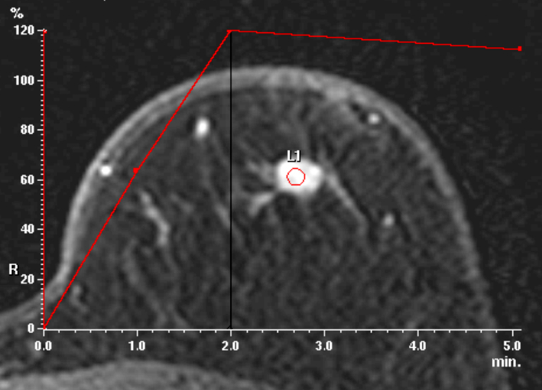 症例17 70歳 女性 浸潤性乳管癌 硬癌 ダイナミックMRI 時間信号曲線