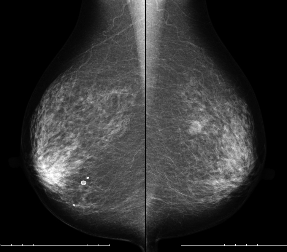 症例18 71歳 女性 浸潤性乳管癌 充実腺管癌 マンモグラフィ MLO