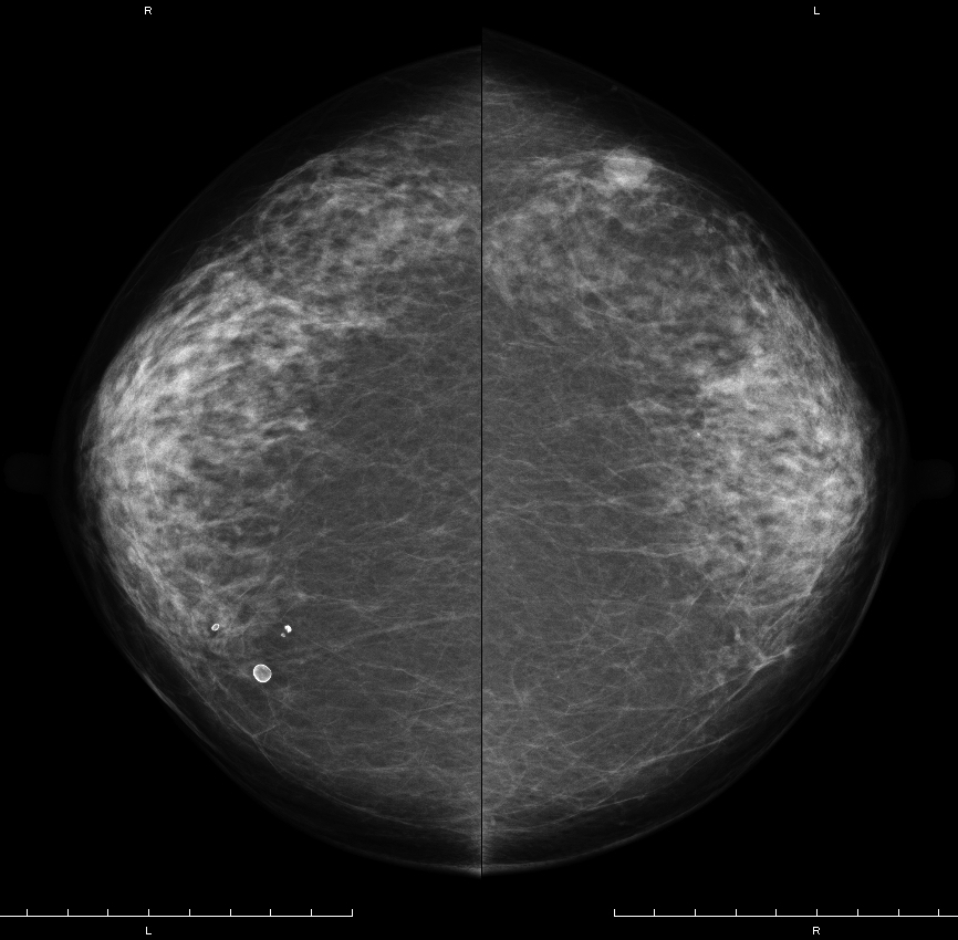 症例18 71歳 女性 浸潤性乳管癌 充実腺管癌 マンモグラフィ CC