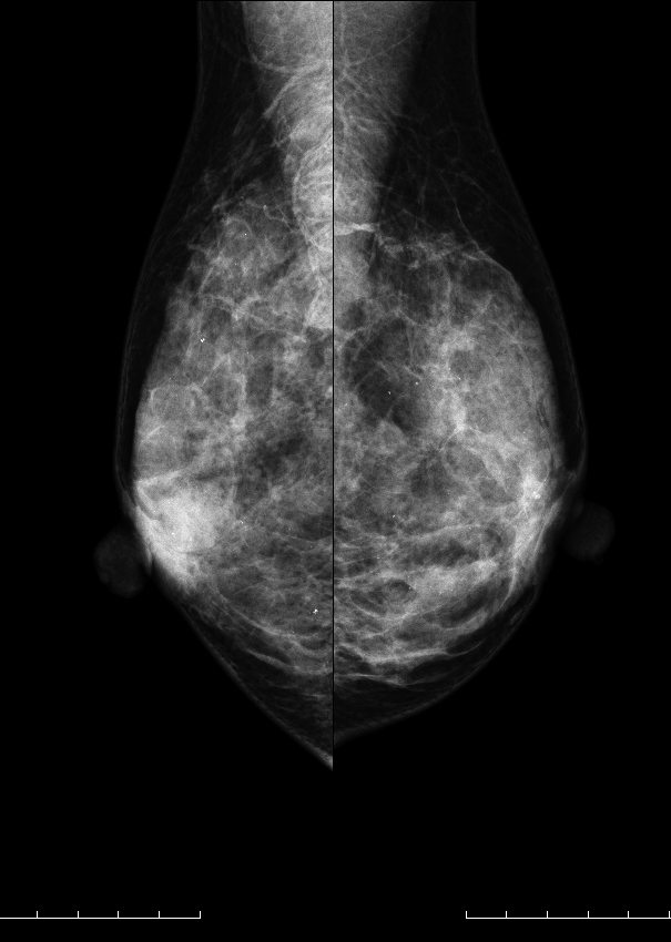 症例19 42歳 女性 浸潤性乳管癌 硬癌 マンモグラフィ MLO