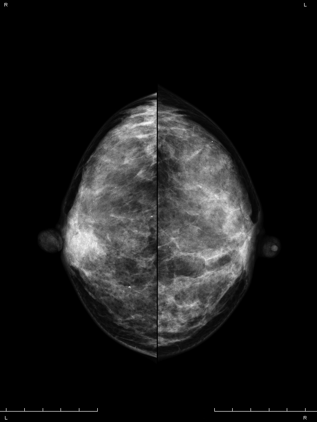 症例19 42歳 女性 浸潤性乳管癌 硬癌 マンモグラフィ CC
