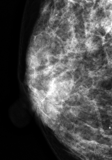 症例19 42歳 女性 浸潤性乳管癌 硬癌 マンモグラフィ 右MLO拡大スポット撮影