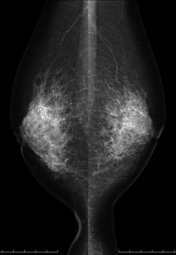 症例20 71歳 女性 DCIS 面疱型 マンモグラフィ MLO