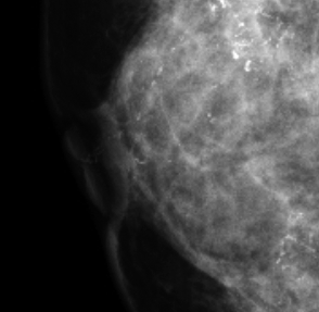 症例20 71歳 女性 DCIS 面疱型 マンモグラフィ 右MLO乳頭部拡大像