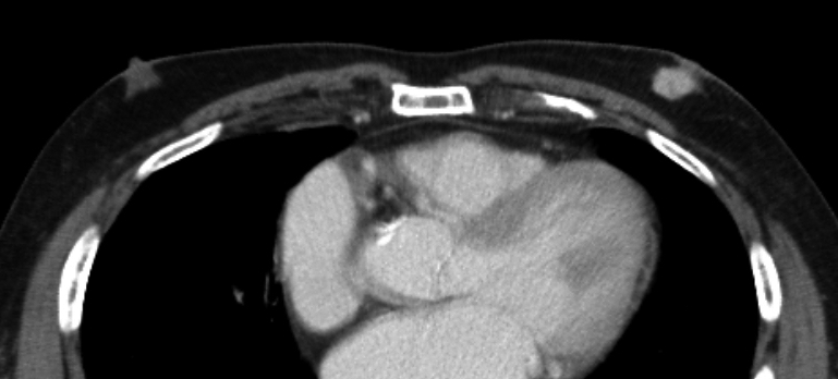 症例21 74歳 男性 浸潤性乳管癌 充実腺管癌 女性化乳房症 術前造影CT