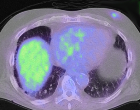 症例21 74歳 男性 アルコール性肝硬変 肝腫瘤 PET-CT
