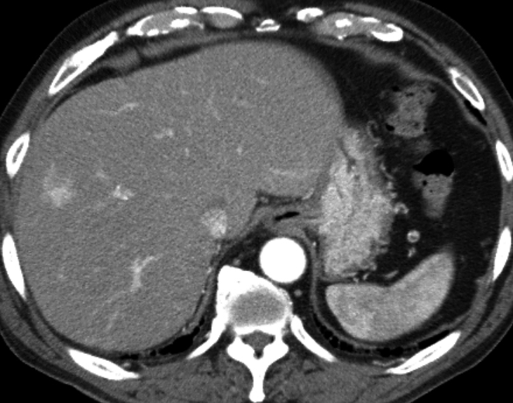 症例21 74歳 男性 アルコール性肝硬変 肝腫瘤 ダイナミックCT 動脈相