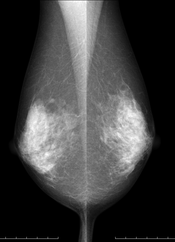 症例22 66歳 女性 浸潤性乳管癌 充実腺管癌 乳房内リンパ節 マンモグラフィ MLO