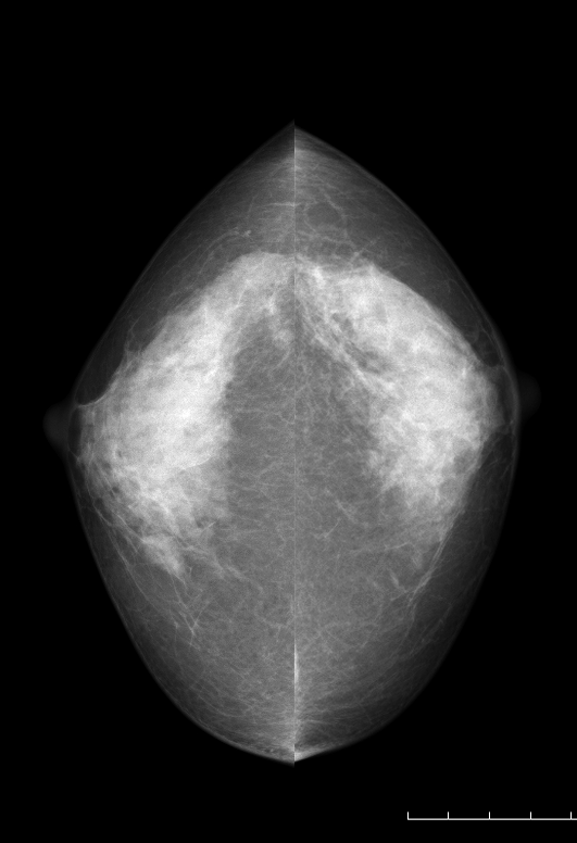 症例22 66歳 女性 浸潤性乳管癌 充実腺管癌 乳房内リンパ節 マンモグラフィ CC