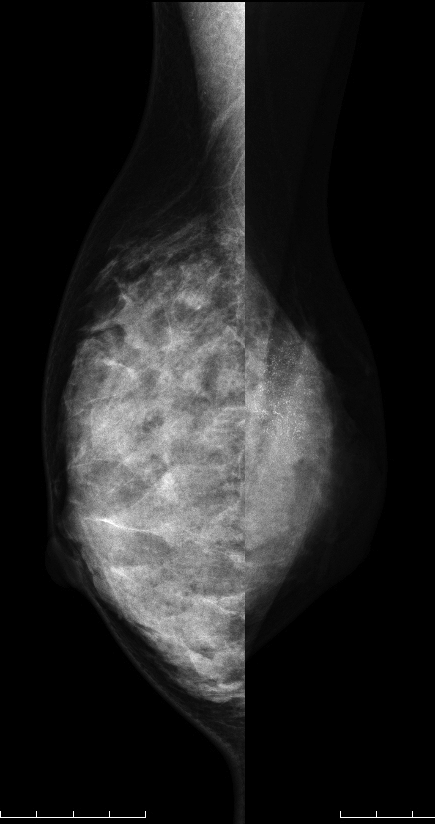 症例23 39歳 女性 浸潤性小葉癌 マンモグラフィ MLO