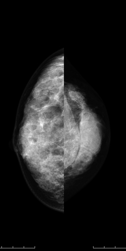 症例23 39歳 女性 浸潤性小葉癌 マンモグラフィ CC