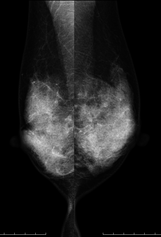 症例24 42歳 女性 浸潤性乳管癌 硬癌 線維腺腫 マンモグラフィ MLO