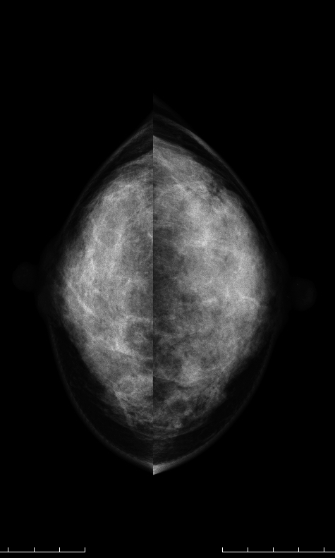 症例24 42歳 女性 浸潤性乳管癌 硬癌 線維腺腫 マンモグラフィ CC