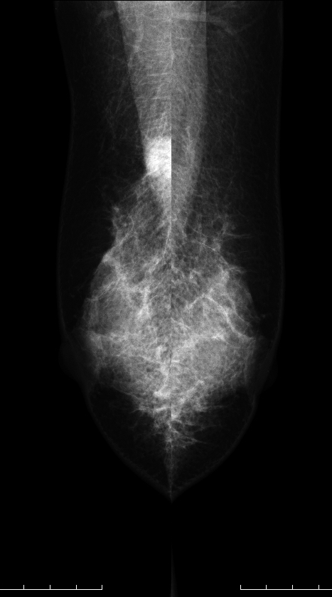 症例25 51歳 女性 浸潤性乳管癌 硬癌 マンモグラフィ MLO