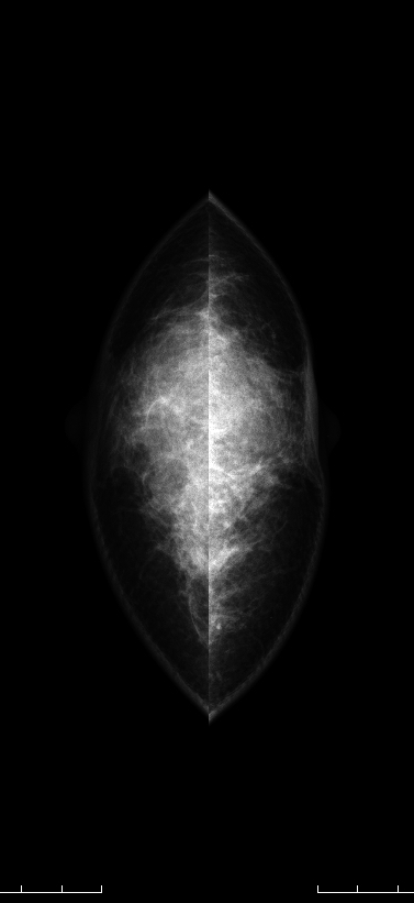 症例25 51歳 女性 浸潤性乳管癌 硬癌 マンモグラフィ CC