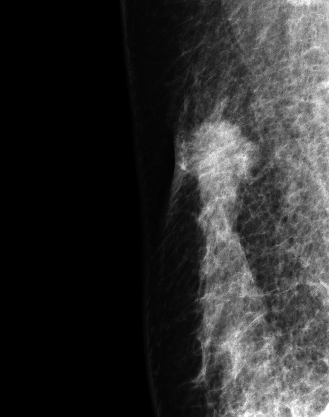 症例25 51歳 女性 浸潤性乳管癌 硬癌 マンモグラフィ 右MLO拡大スポット撮影