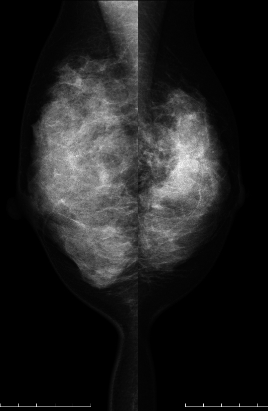 症例26 37歳 女性 浸潤性乳管癌 硬癌 マンモグラフィ MLO