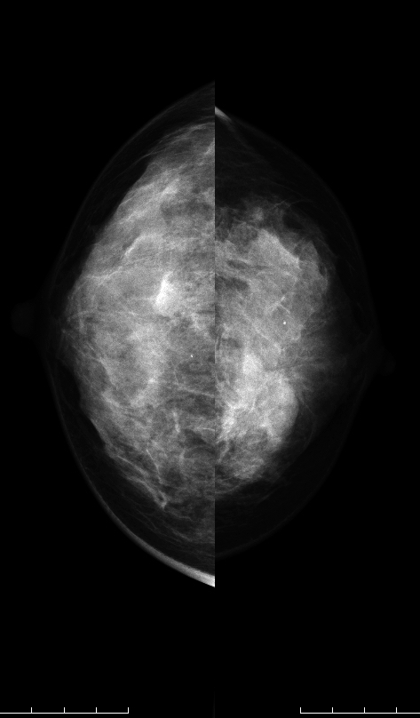 症例26 37歳 女性 浸潤性乳管癌 硬癌 マンモグラフィ CC
