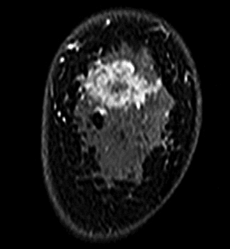 症例26 37歳 女性 浸潤性乳管癌 硬癌 術前造影MRI 冠状断像