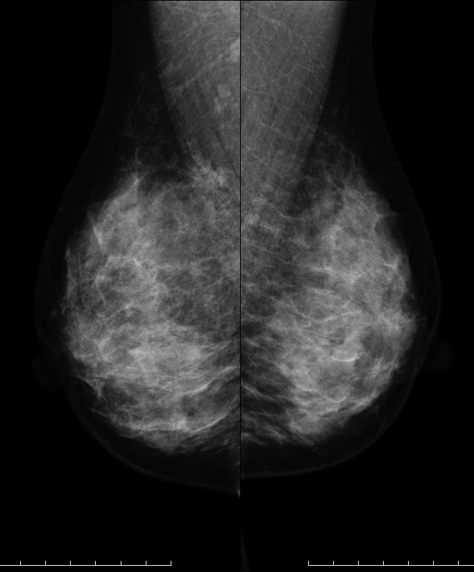 症例27 50歳 女性 浸潤性乳管癌 乳頭腺管癌 マンモグラフィ MLO