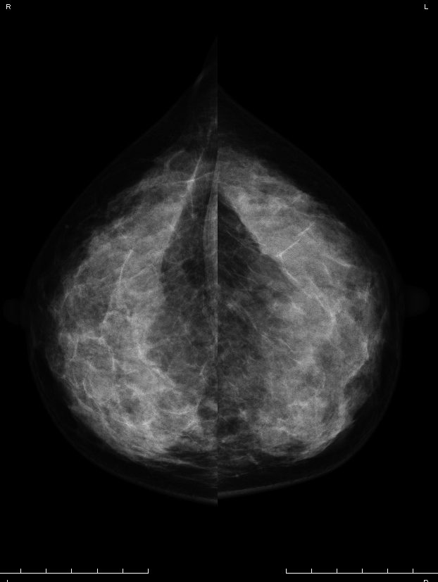 症例27 50歳 女性 浸潤性乳管癌 乳頭腺管癌 マンモグラフィ CC