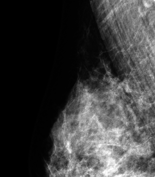 症例27 50歳 女性 浸潤性乳管癌 乳頭腺管癌 マンモグラフィ 右MLO拡大スポット撮影