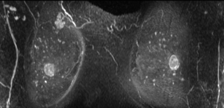 症例27 50歳 女性 浸潤性乳管癌 乳頭腺管癌 術前造影MRI