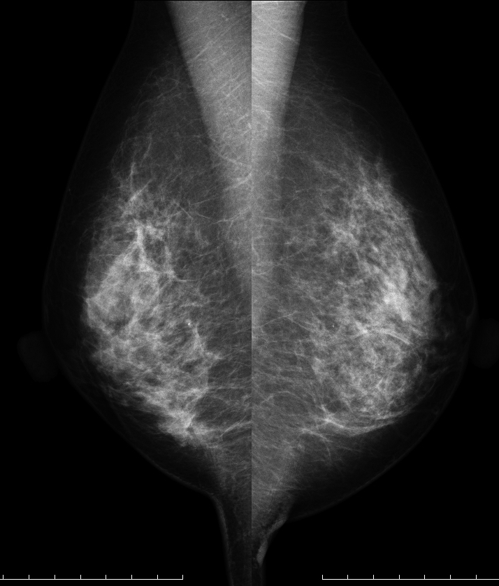 症例28 51歳 女性 粘液癌 混合型 充実腺管癌 過誤腫 マンモグラフィ MLO