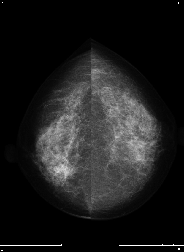 症例28 51歳 女性 粘液癌 混合型 充実腺管癌 過誤腫 マンモグラフィ CC