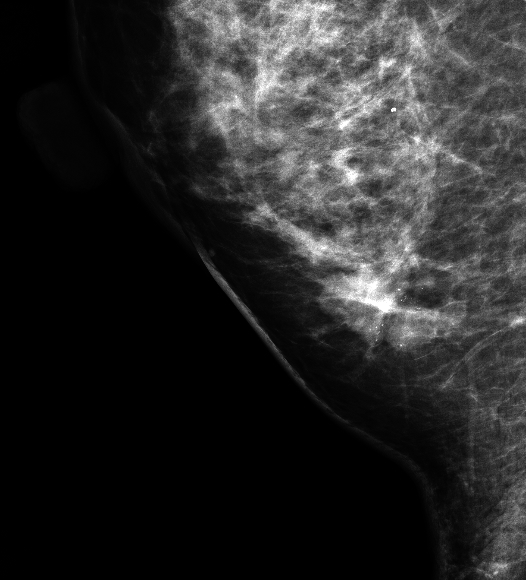 症例28 51歳 女性 粘液癌 混合型 充実腺管癌 マンモグラフィ 右MLO拡大スポット撮影
