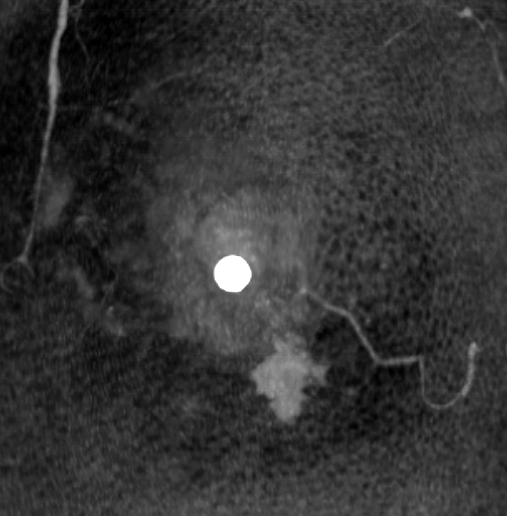 症例28 51歳 女性 粘液癌 混合型 充実腺管癌 術前造影3D-CT