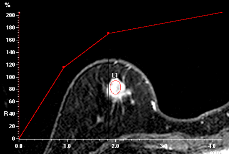 症例28 51歳 女性 粘液癌 混合型 充実腺管癌 術前造影MRI ダイナミック撮像 時間信号曲線