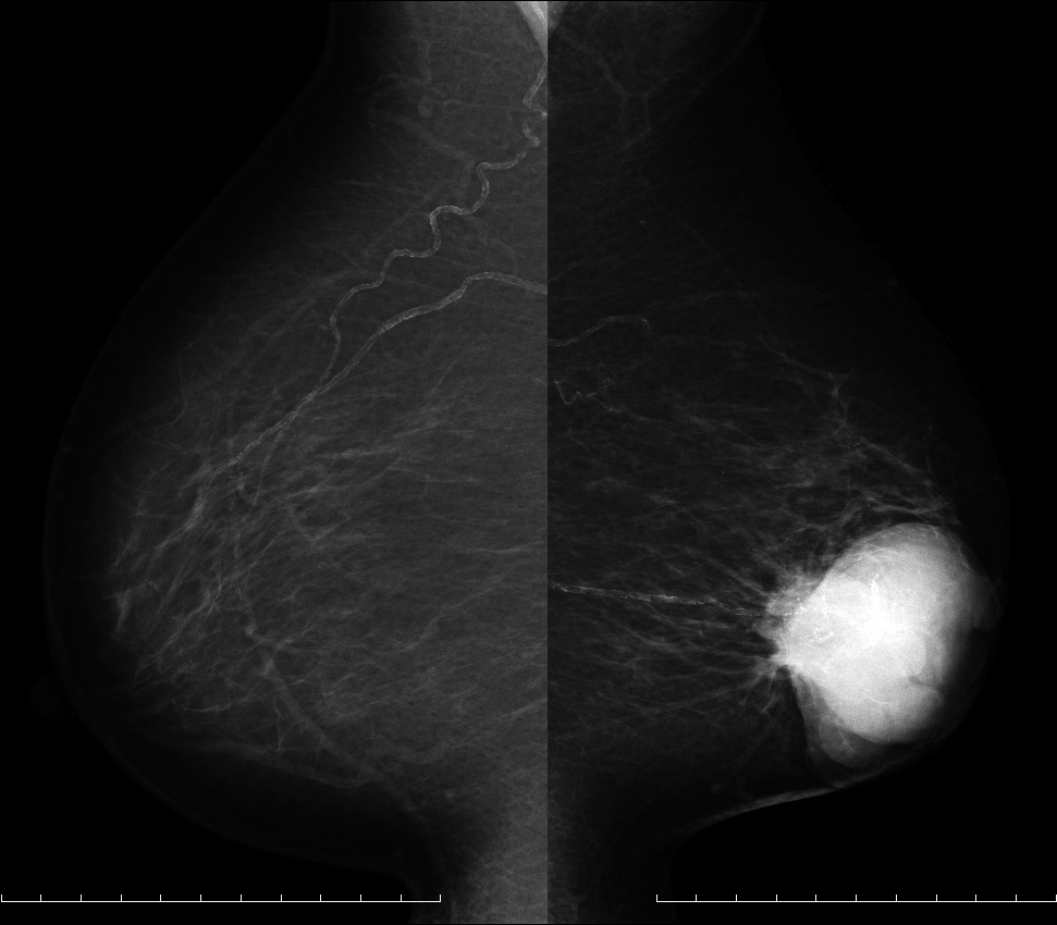 症例29 69歳 女性 浸潤性乳管癌 硬癌 マンモグラフィ MLO