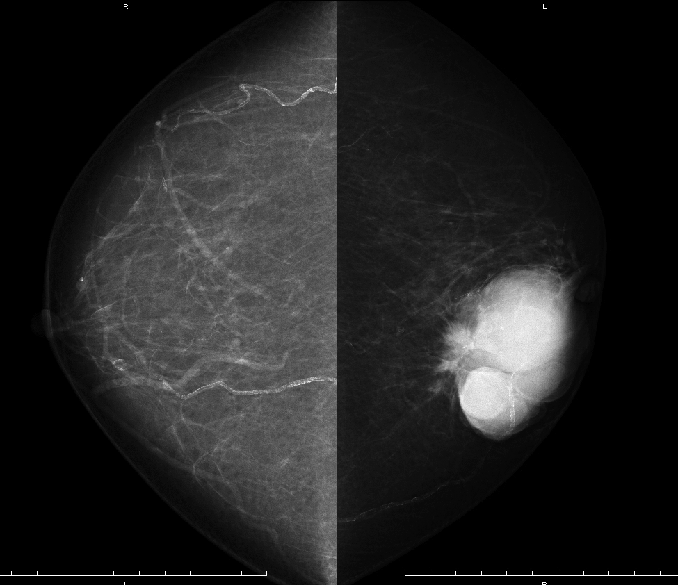 症例29 69歳 女性 浸潤性乳管癌 硬癌 マンモグラフィ CC